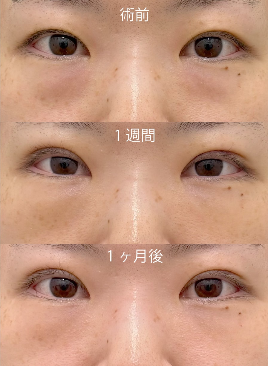 30代女性のダウンタイム