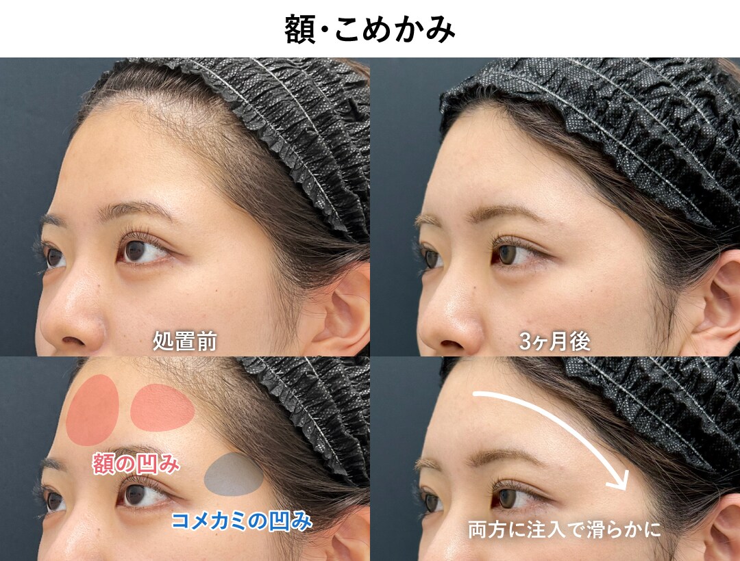 「額」をするなら「コメカミ」もセットがオススメ！