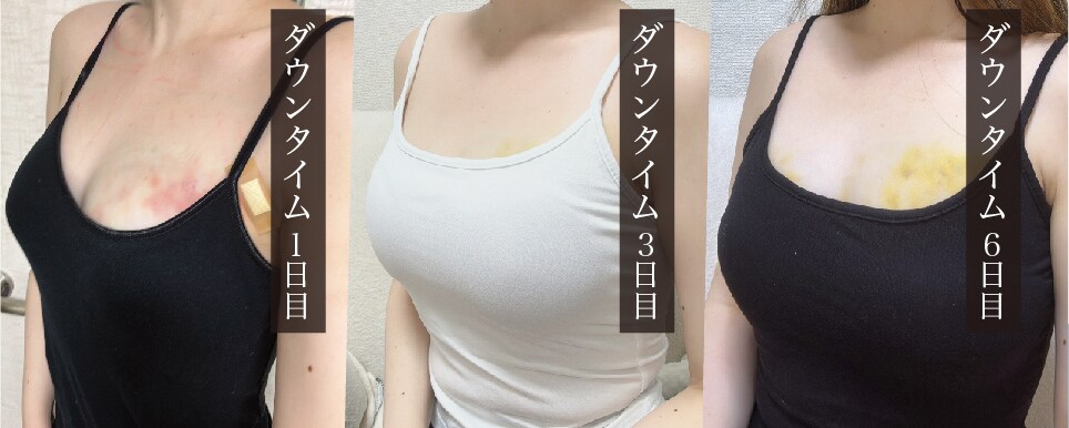 脂肪注入豊胸
