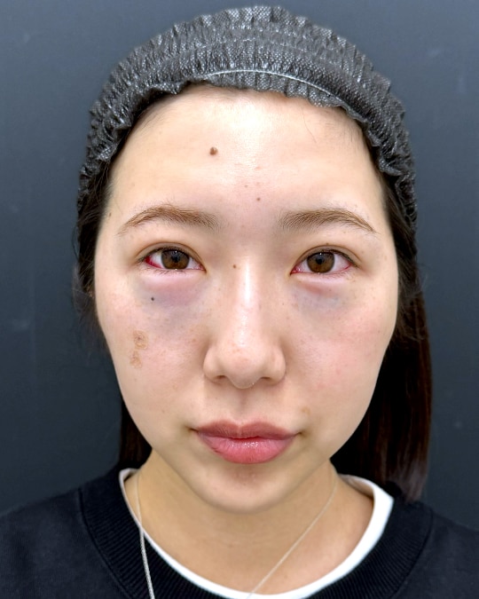 施術直後　メイクなし