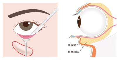②皮膚表面に傷が残らない: 