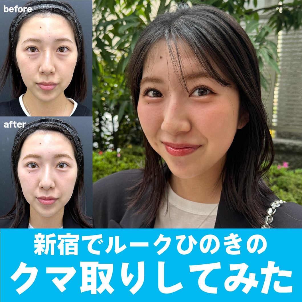 【クマ取り】新宿でクマ取りするならルークひのきにお任せ【湘南美容クリニック新宿南口院】