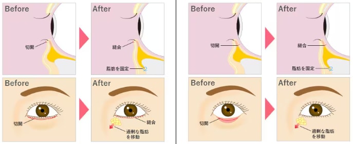切開ハムラ法と裏ハムラ法の違い