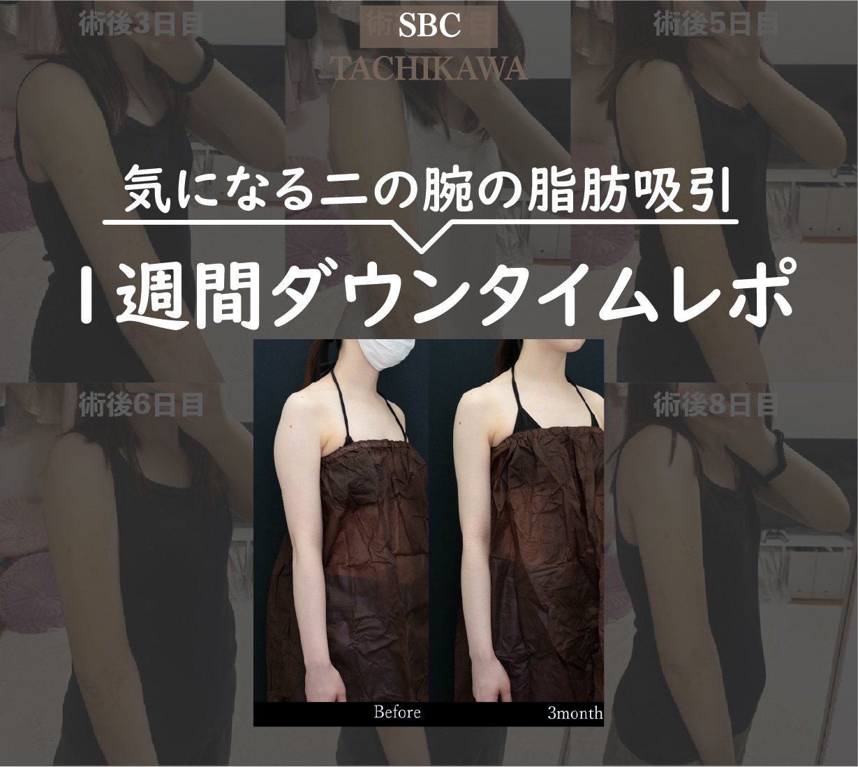 【思ったより平気?】スタッフ実体験で見る脂肪吸引ダウンタイム