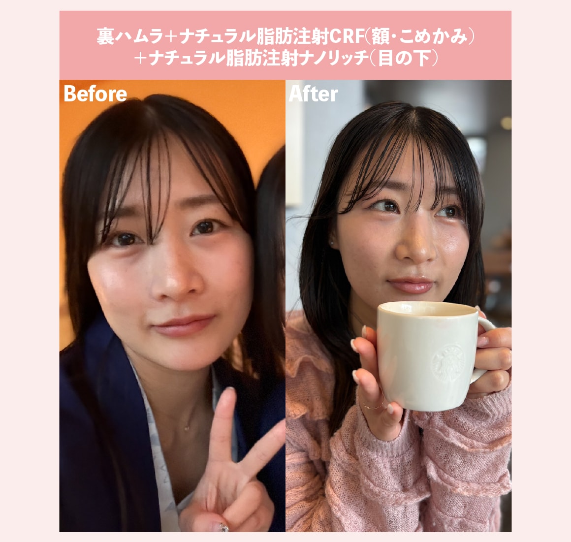 クマ取り