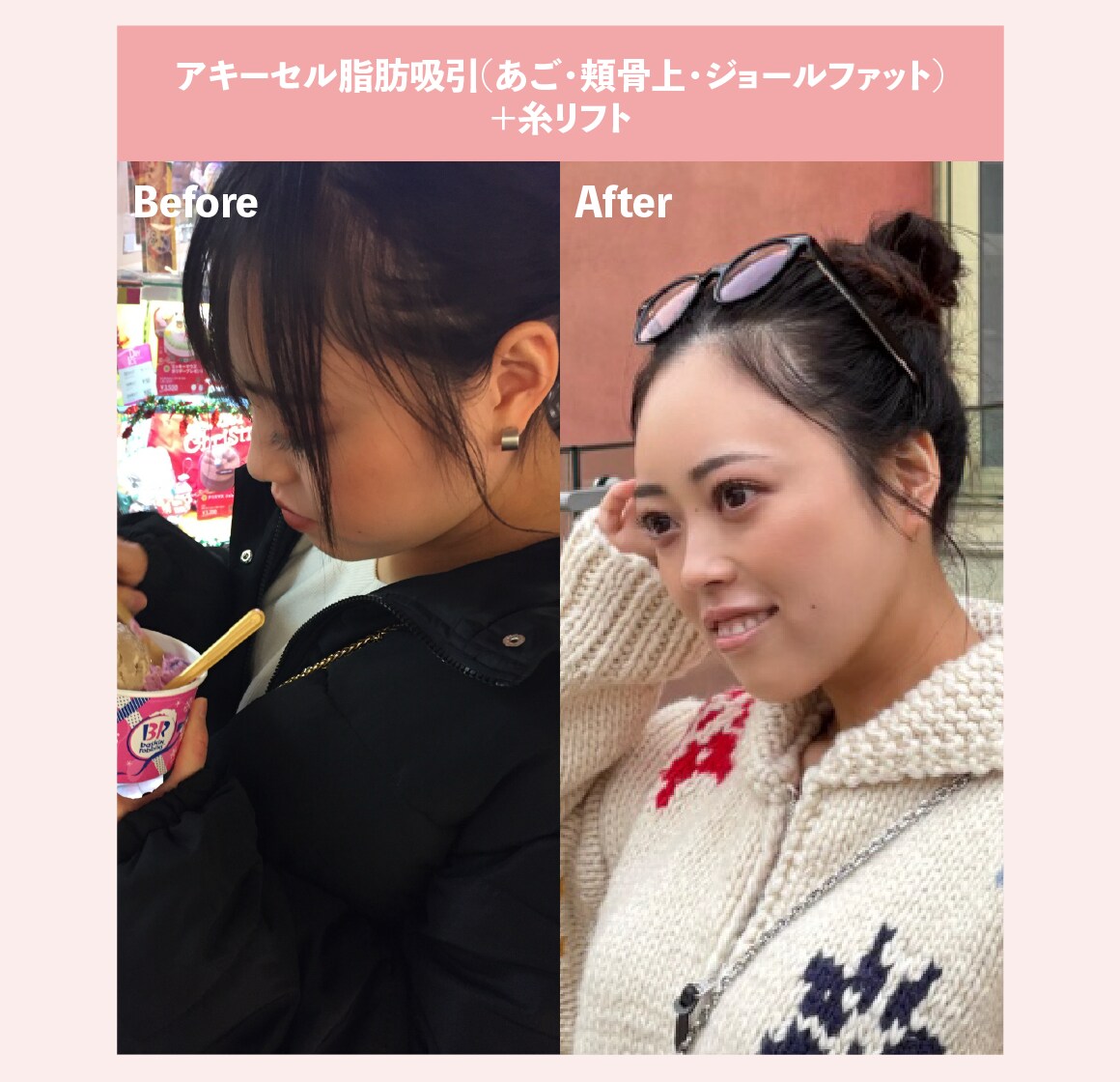 【脂肪吸引】