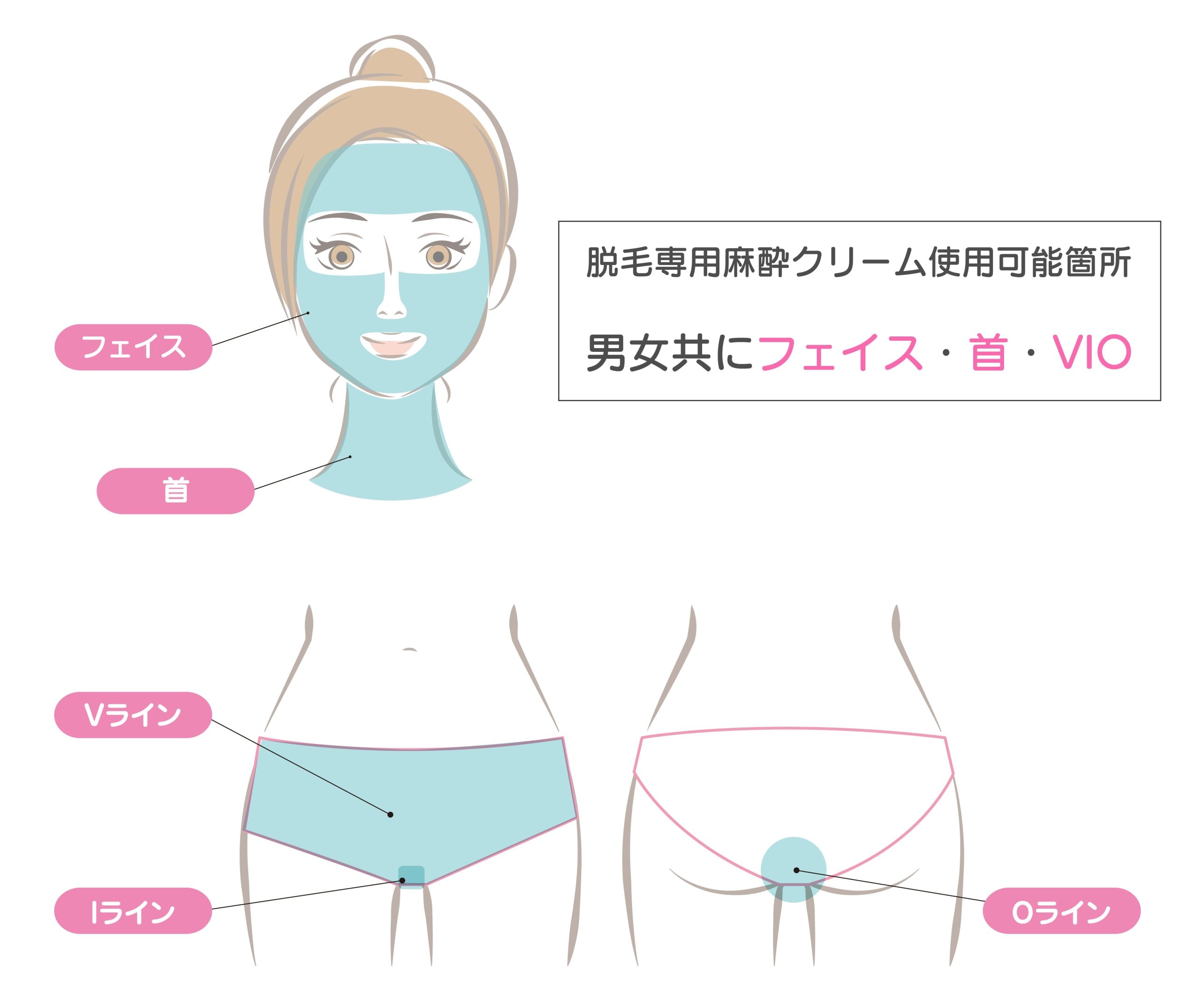 脱毛専用クリーム(エムラクリーム)の範囲拡大