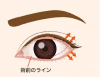 併用施術で美しいカーブの目元へ