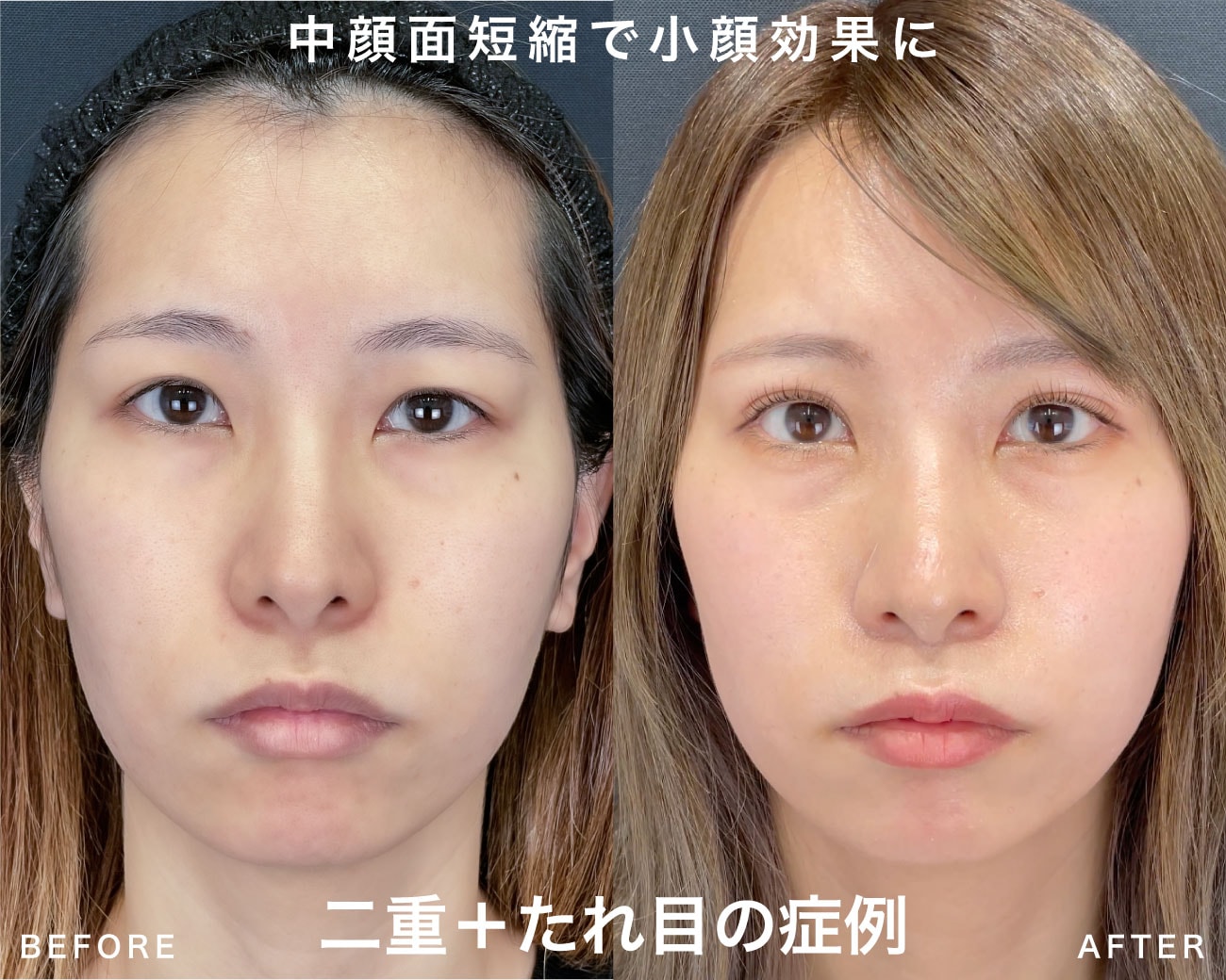 中顔面短縮効果あり