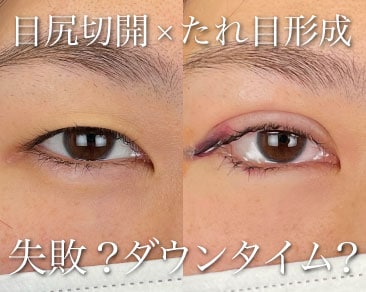 【整形失敗】たれ目形成(グラマラスライン)で後悔しないために