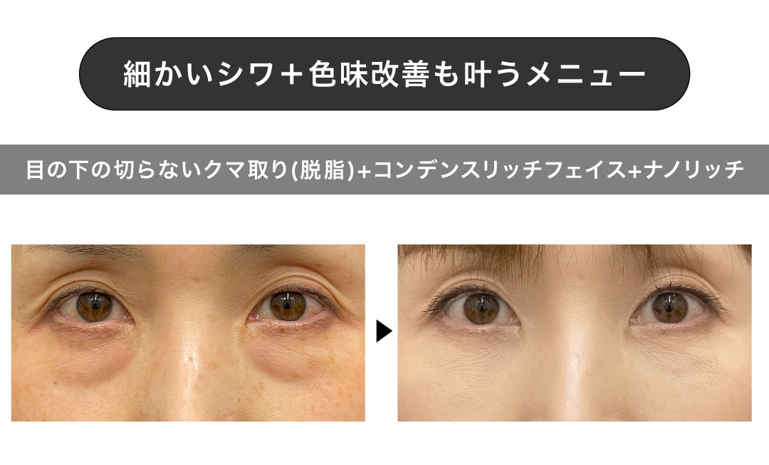 細かいシワ＋色味改善も叶うメニュー【目の下の切らないクマ取り(脱脂)+コンデンスリッチフェイス+ナノリッチ】
