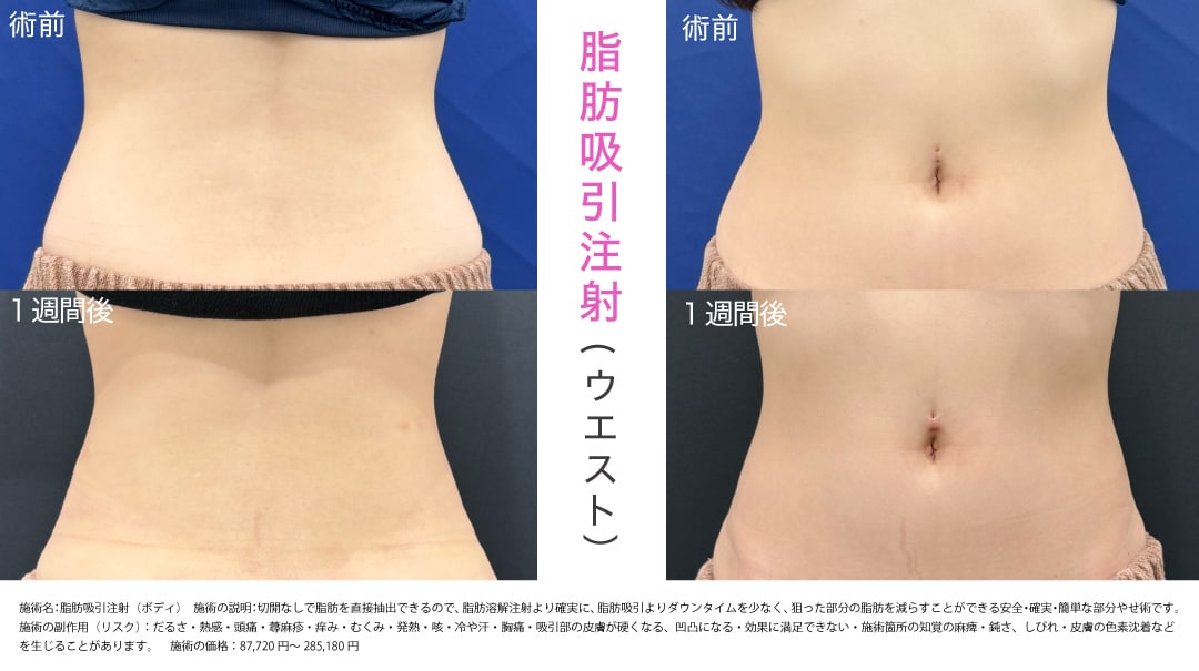 きゅっと綺麗なくびれに憧れる方