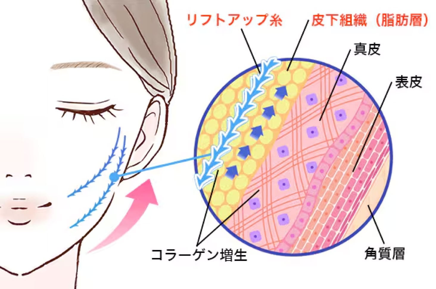 糸リフトってどんな施術？
