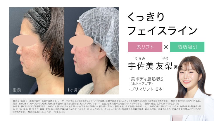 糸リフト×脂肪吸引