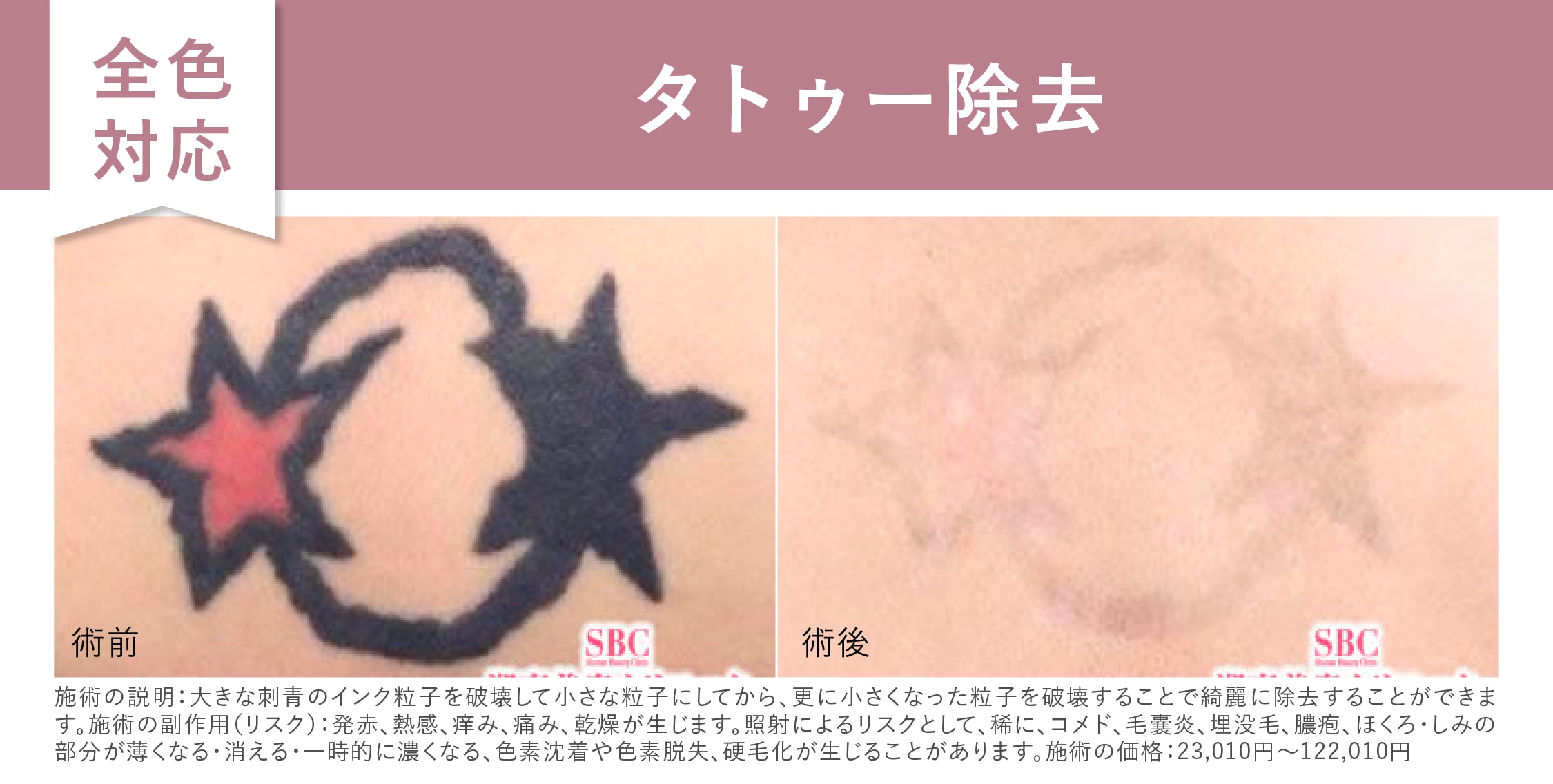 【全色対応】タトゥー除去