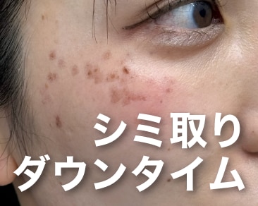 シミ取りレーザーのダウンタイムは？経過紹介します！湘南美容クリニック高崎院なら人気のピコレーザーあります！