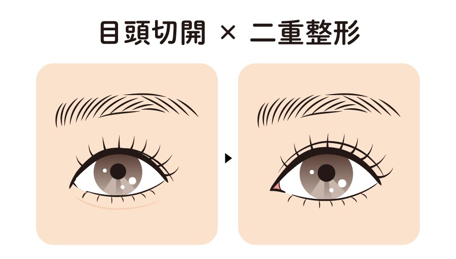 目頭切開 × 埋没法二重術(全切開二重術)