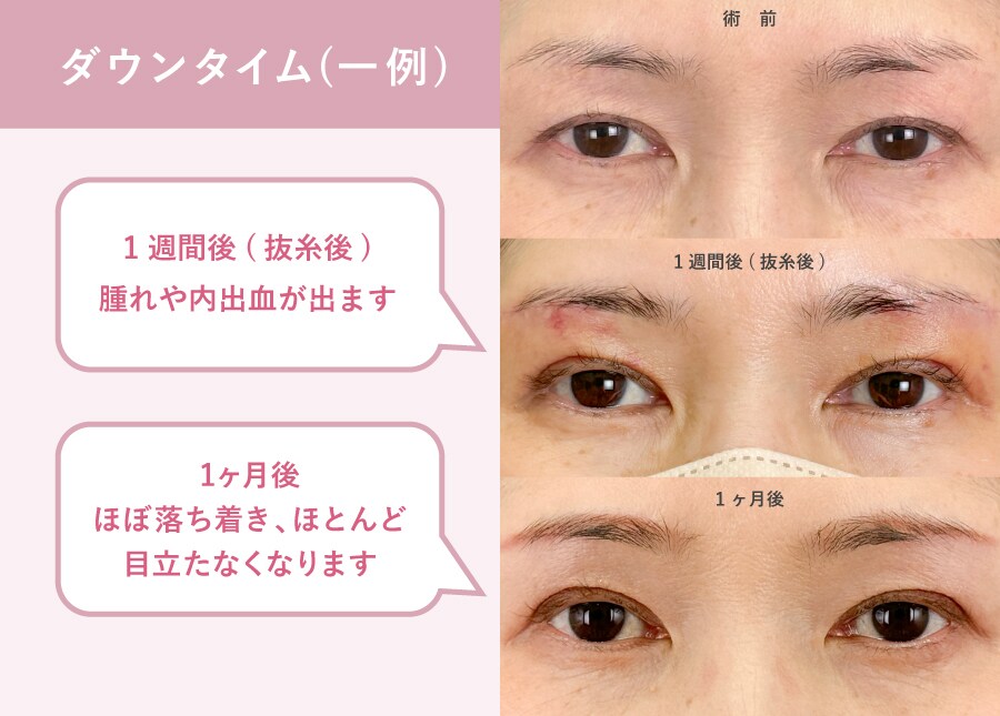 腫れ・内出血の目安