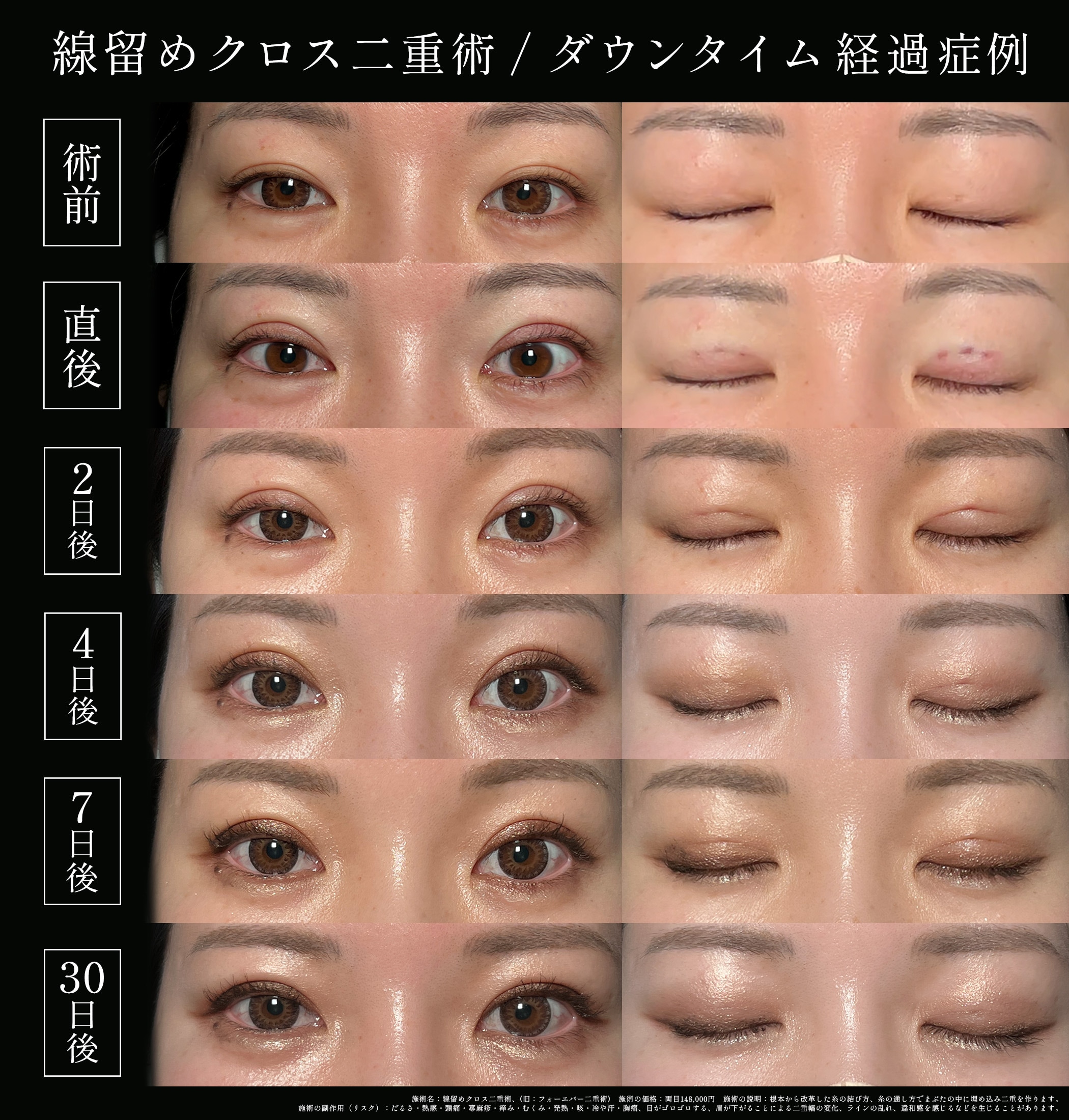 30代女性のフォーエバー二重術(旧線留めクロス二重術)症例