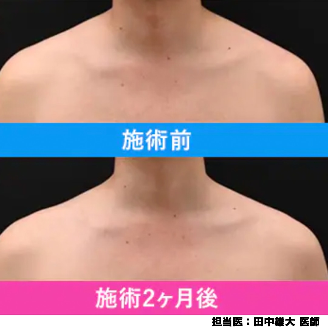 肩の筋肉にボトックスを注射することで、<br />
肩のラインをなだらかに整えたり、肩こりを和らげる施術