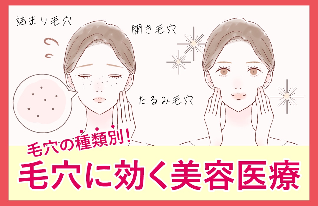 富山県で毛穴の美容医療をするなら湘南美容クリニック！黒ずみ毛穴、開き・たるみ毛穴、詰まり毛穴を改善