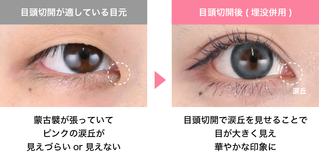 目頭切開