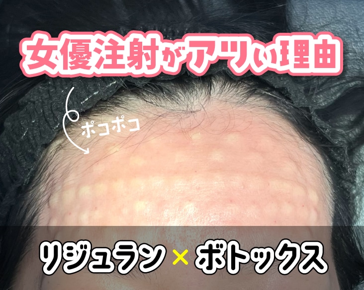 今、女優注射がアツい