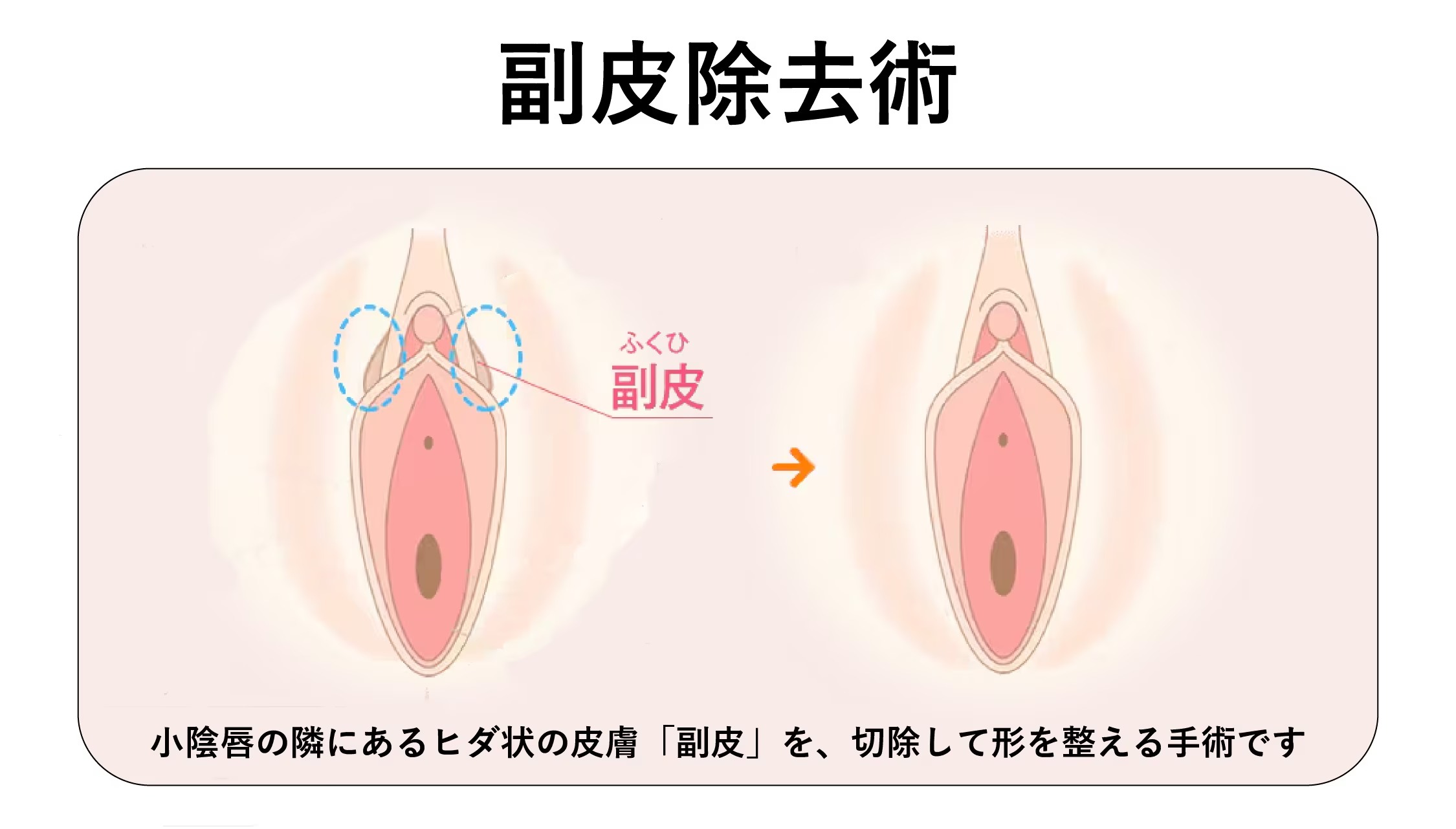 副皮除去術