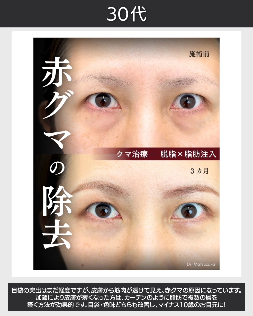 老け見えする筋肉や血管の透け感の