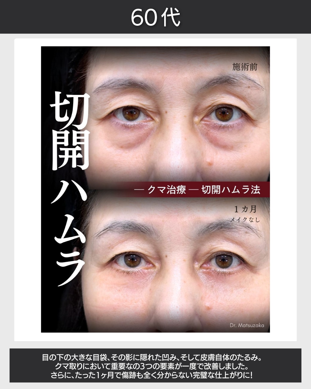 切るクマ取りなら伸びきった皮膚も