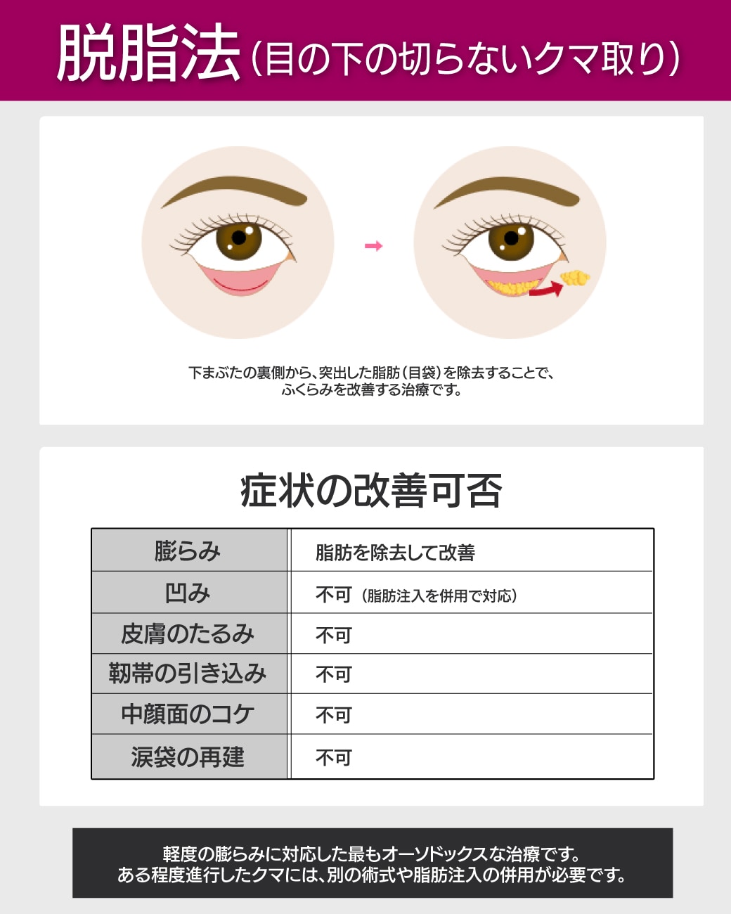 【目の下の切らないクマ・たるみ（ふくらみ）取り（脱脂法）】ダウンタイム最小限。脂肪の膨らみだけをリセット