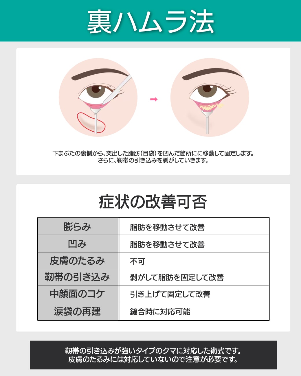 【裏ハムラ法】表面を切らずに脂肪を再配置。再発を防ぐ高度なテクニック