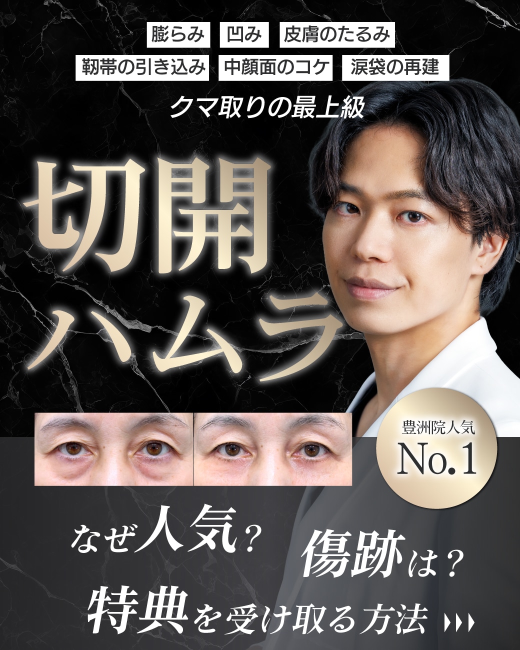 【切開ハムラNo.1】SBC最優秀ドクター松阪医師なら傷跡なし！皮膚のたるみ・中顔面のリフトアップ・涙袋など『全ての悩みが解決』できるクマ取り