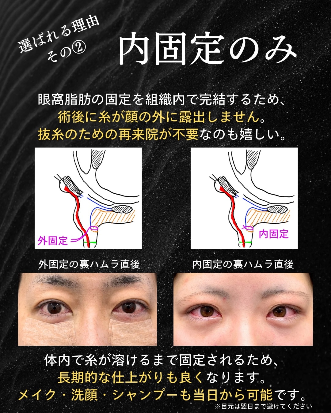 ダウンタイムを軽減する「内固定のみ」の術式