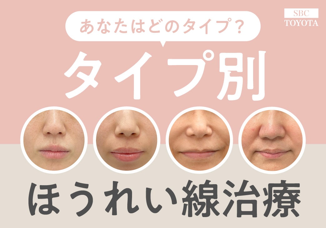 【あなたはどのタイプ？】ほうれい線のタイプ別おすすめ治療を徹底解説｜湘南美容クリニック豊田院