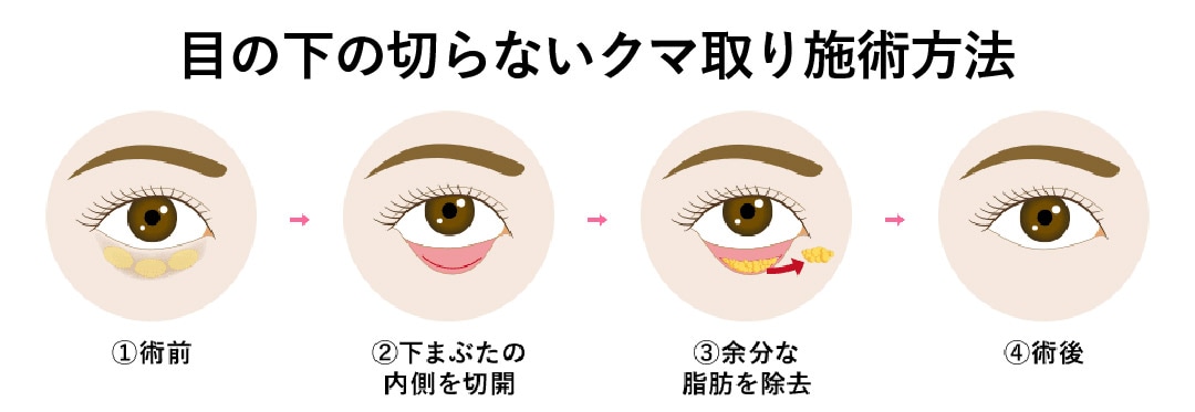 「整形」よりも「目元のメンテナンス」という選択<br />
