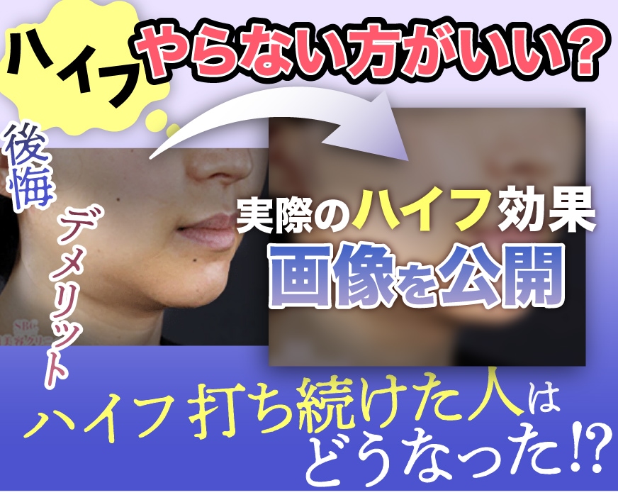 【画像あり】ハイフの効果がやばい？将来たるむデメリット・実際に打ち続けた人の効果を検証！
