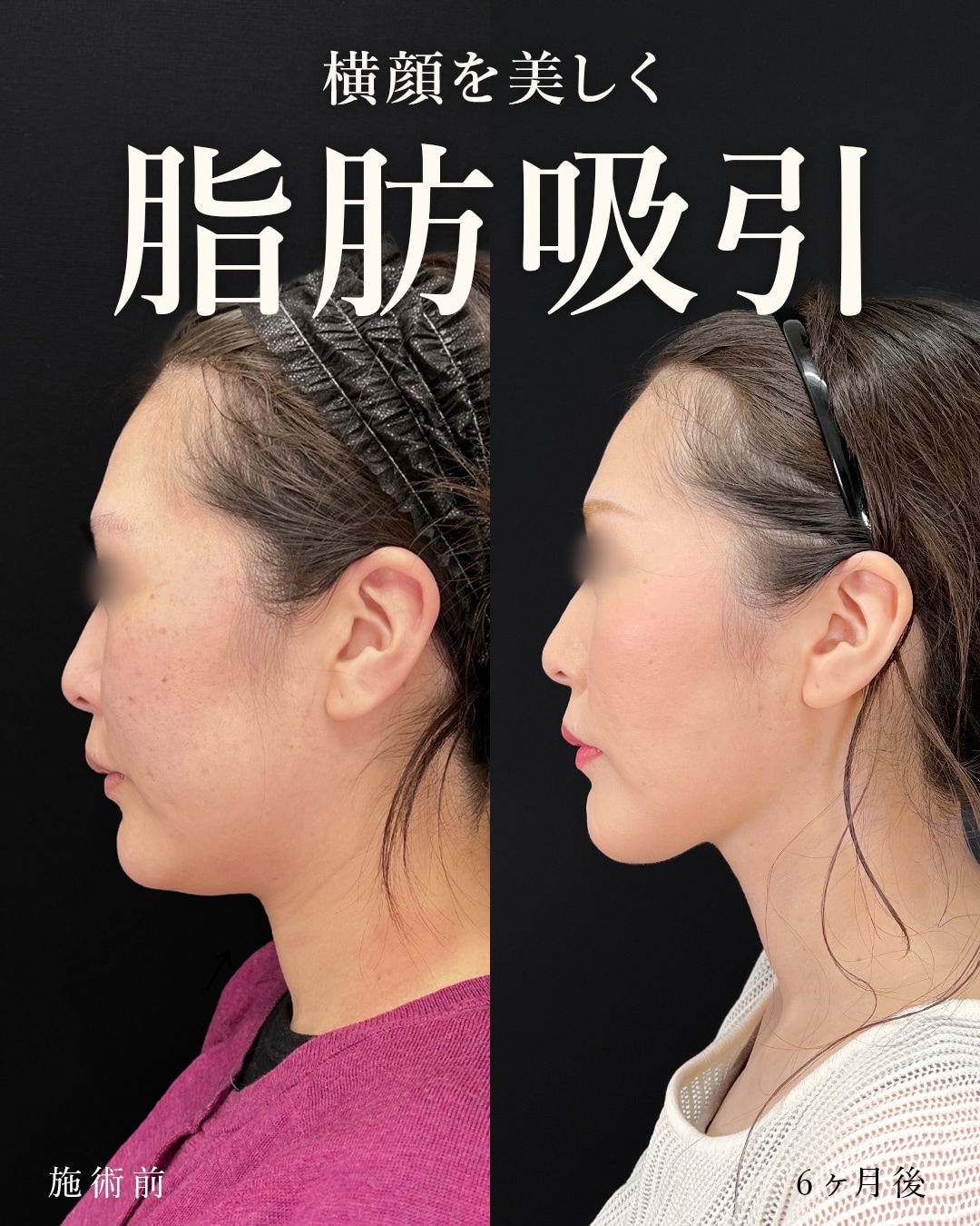 顔の脂肪吸引 症例写真 ビフォーアフター