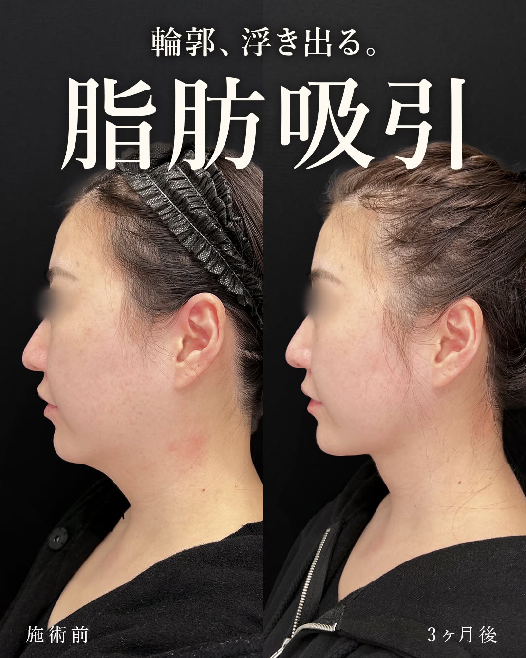 顔の脂肪吸引 症例写真 ビフォーアフター