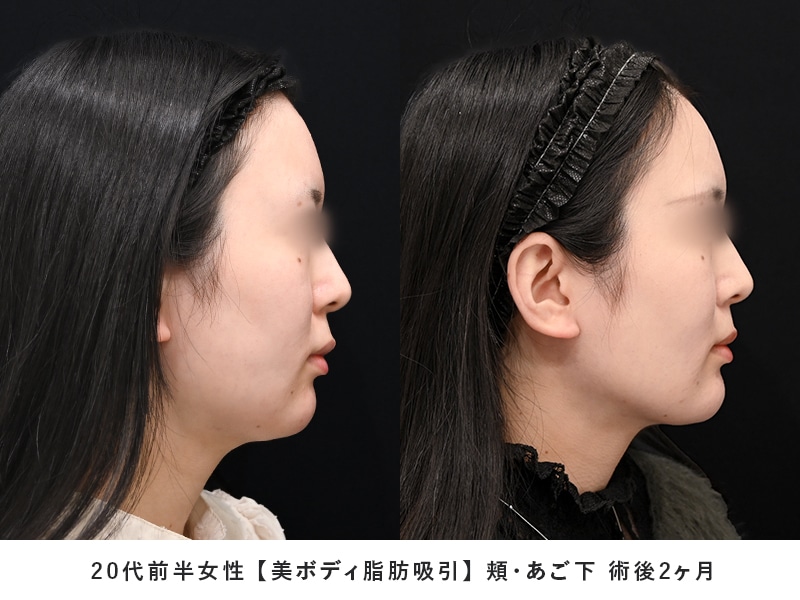 美ボディ脂肪吸引症例2