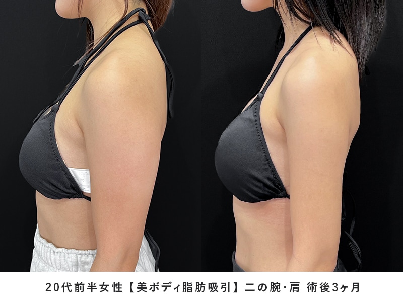 美ボディ脂肪吸引症例3