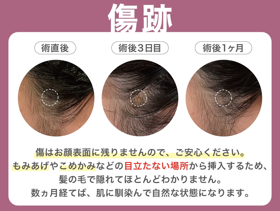 傷跡