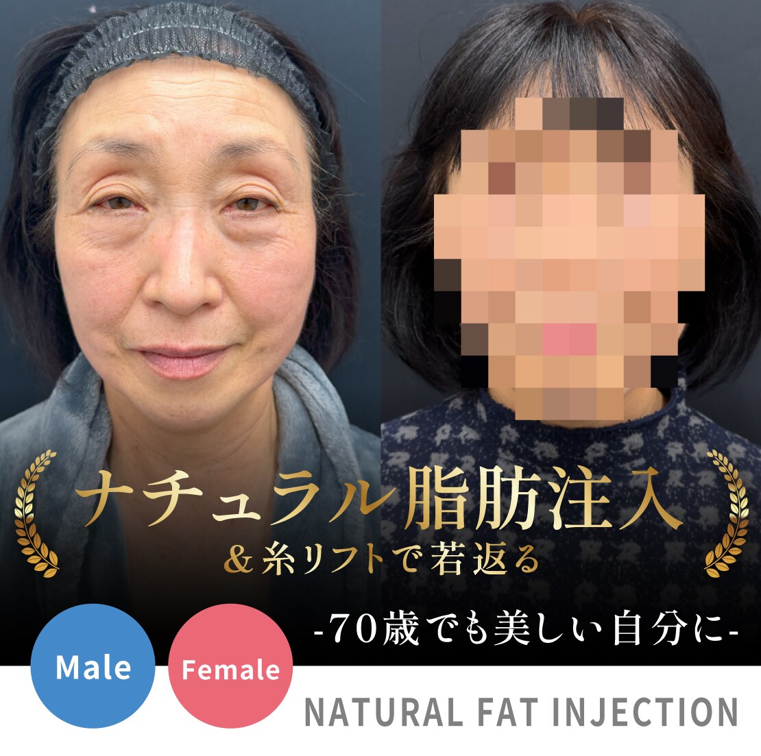 【実録】クマ取り＆ナチュラル脂肪注入！糸リフトも！究極の若返り｜症例写真や解説＆目元のシワを改善【湘南美容クリニック上野院】