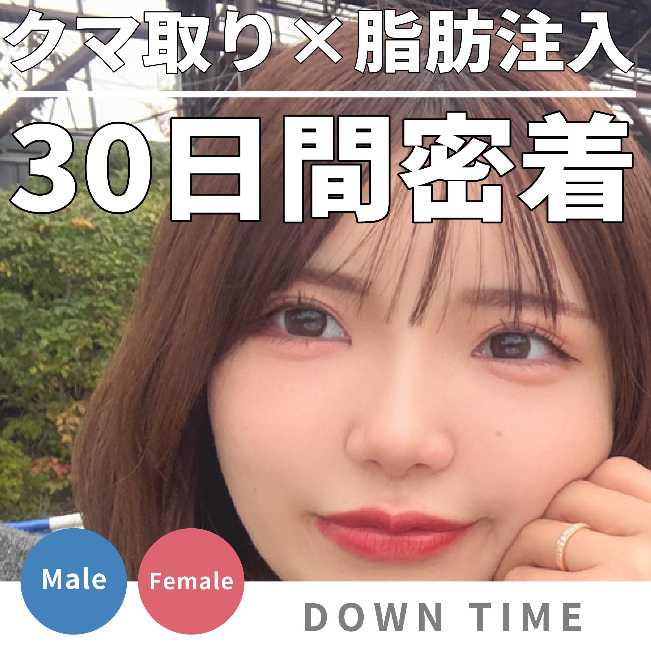 【写真あり】クマ取りダウンタイム30日間完全密着！腫れのピークや仕事復帰はいつ？