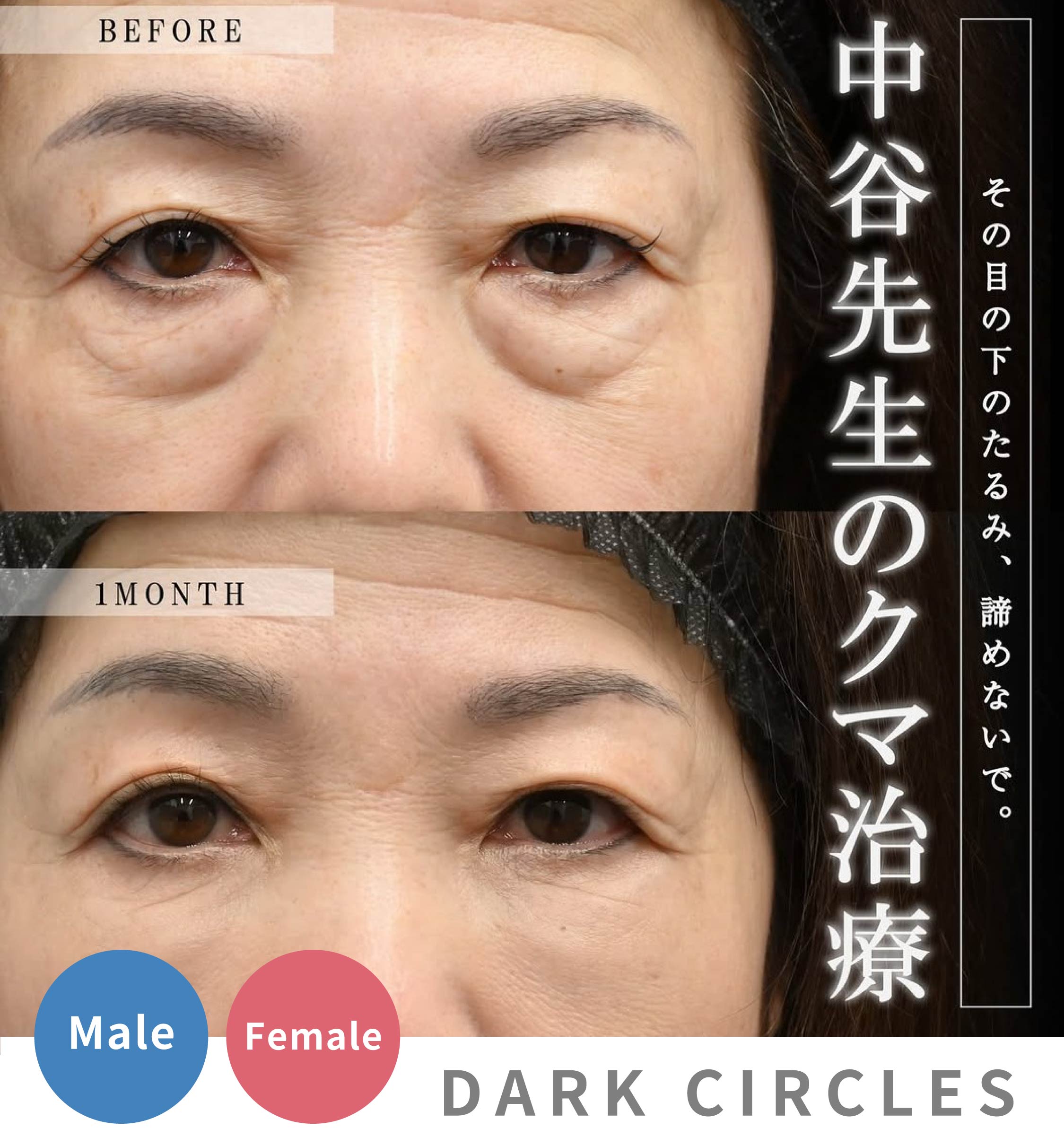 【永久保存版】湘南美容クリニック中谷拓医師の「クマ取り」症例一挙公開！なぜ指名が殺到するのか？