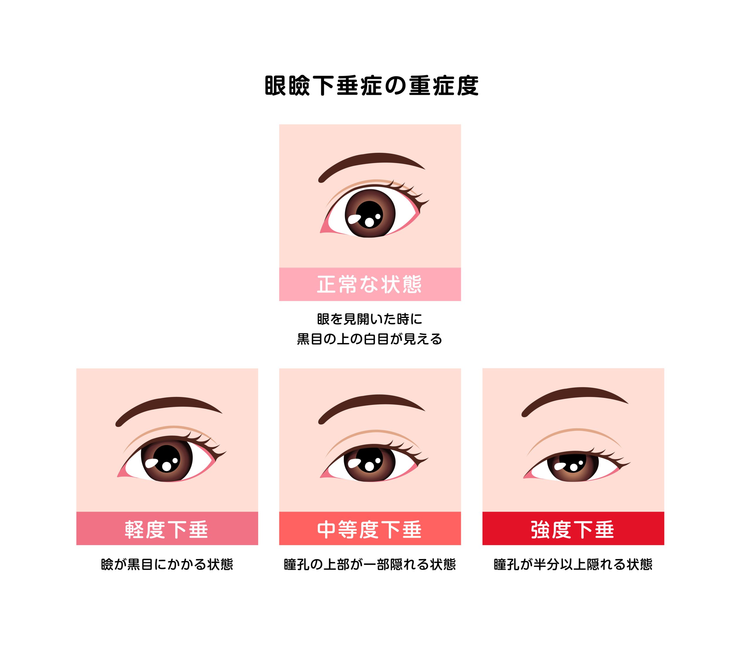 眼瞼下垂イメージ