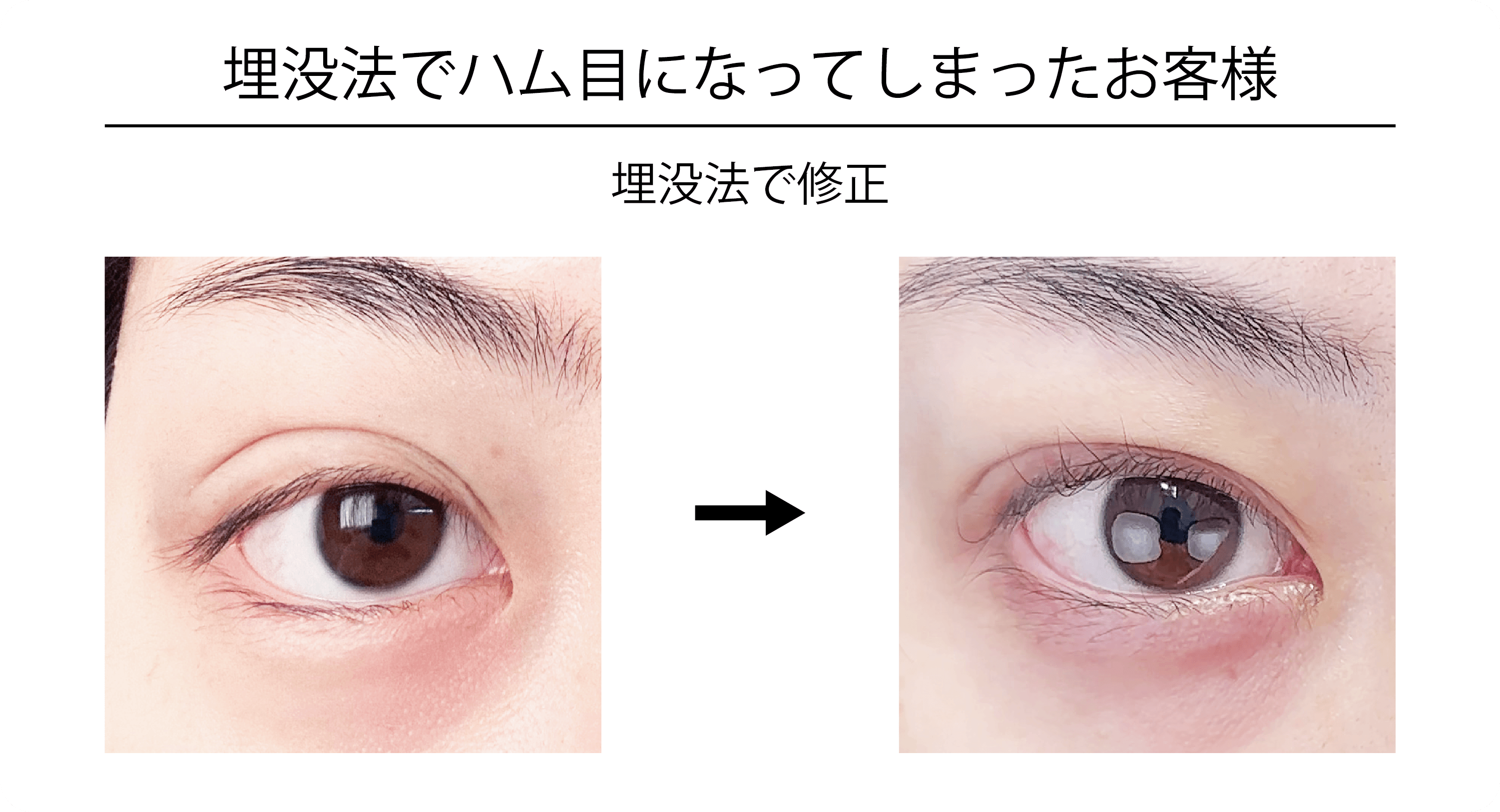 他院修正症例1