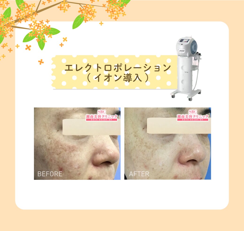 エレクトロポレーション(イオン導入)