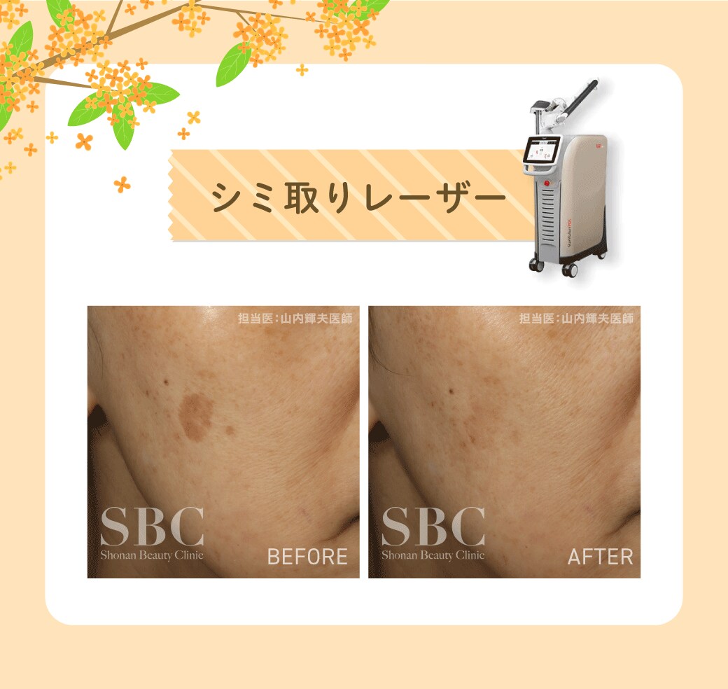 シミ取りレーザー