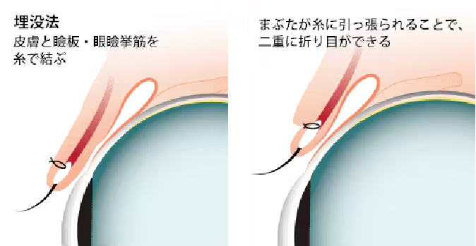 \初心者ならまずはこれ！/埋没法